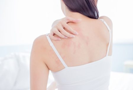 woman with eczema