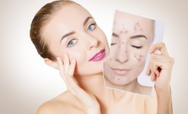 woman holding a photo of herself with acne