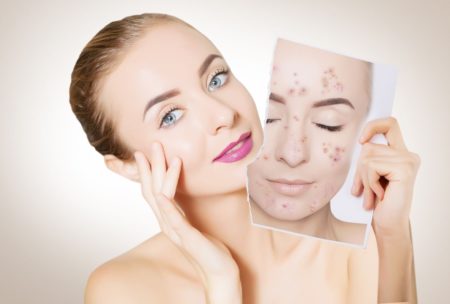 woman holding a photo of herself with acne