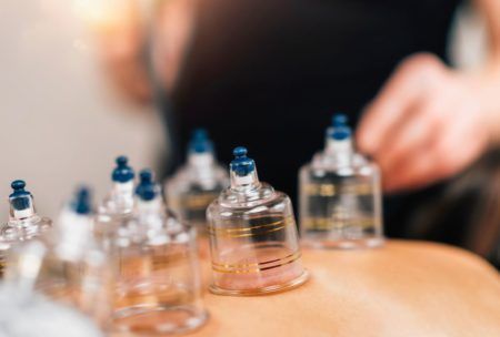 Clinical Cupping Therapy